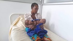 Home 6 Conjoined Twins