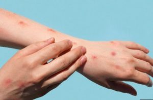 Home 8 Malawi Ministry of Health has said there is no Monkeypox virus in Malawi